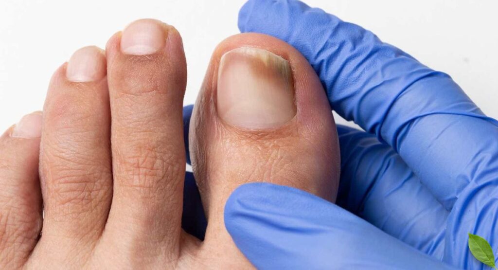 Toenail Fungus recovery after consistent treatment.