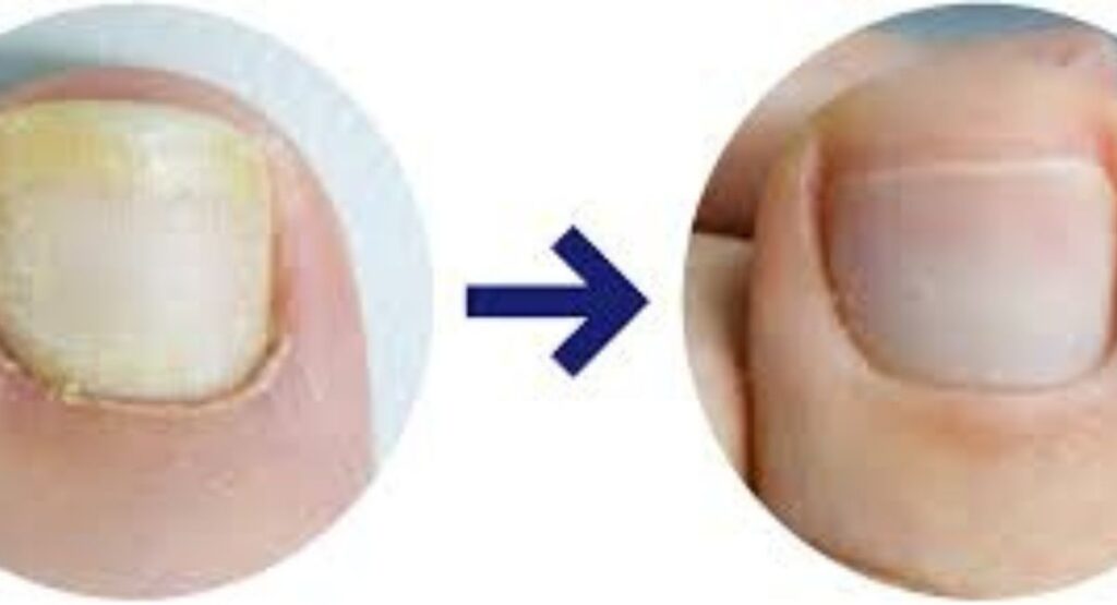 Toenail fungus recovery before and after treatment.