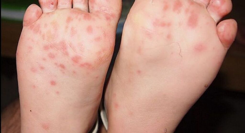 Kids also affected by Athlete's Foot fungus but less as compared to adults.