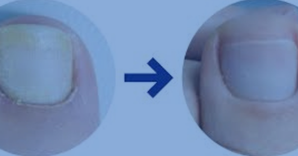 How long does toenail fungus take to heal?