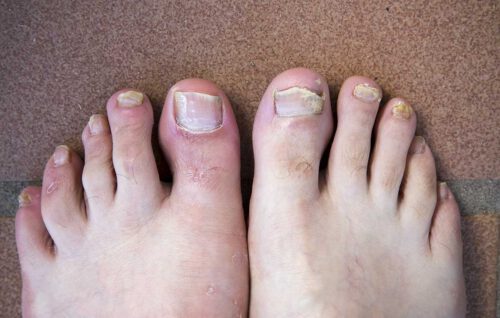New healthy nail 's growth start from the base.