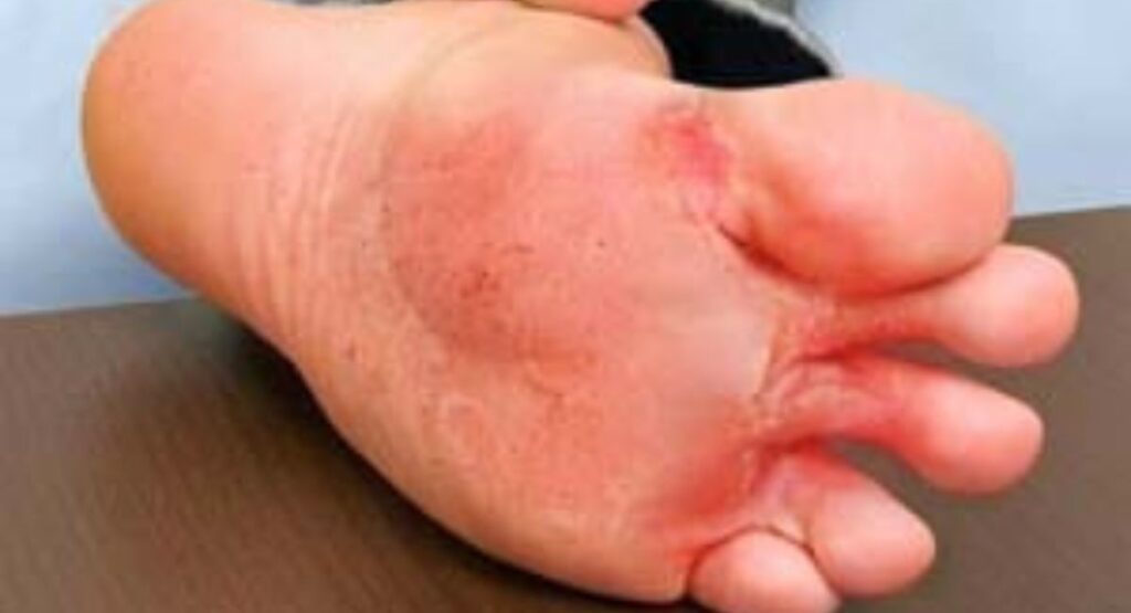 Symptoms between toes.
