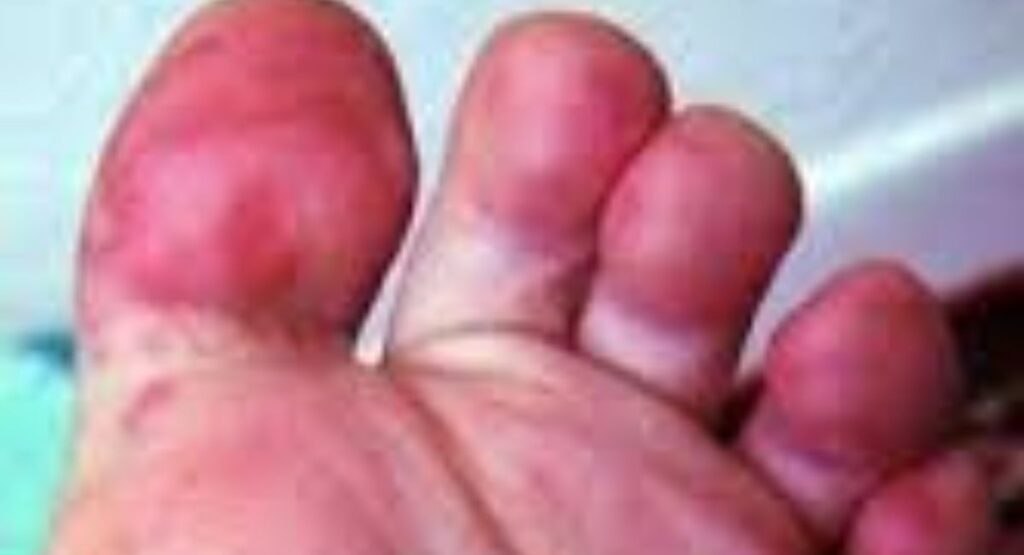 Early symptoms itching.