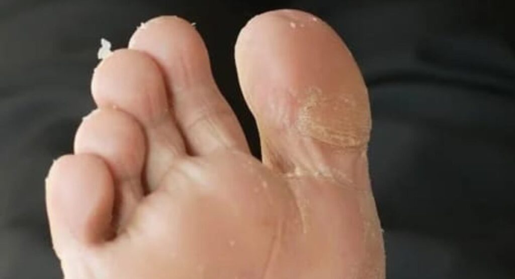 Peeling or dry scaly patches on foot soles.