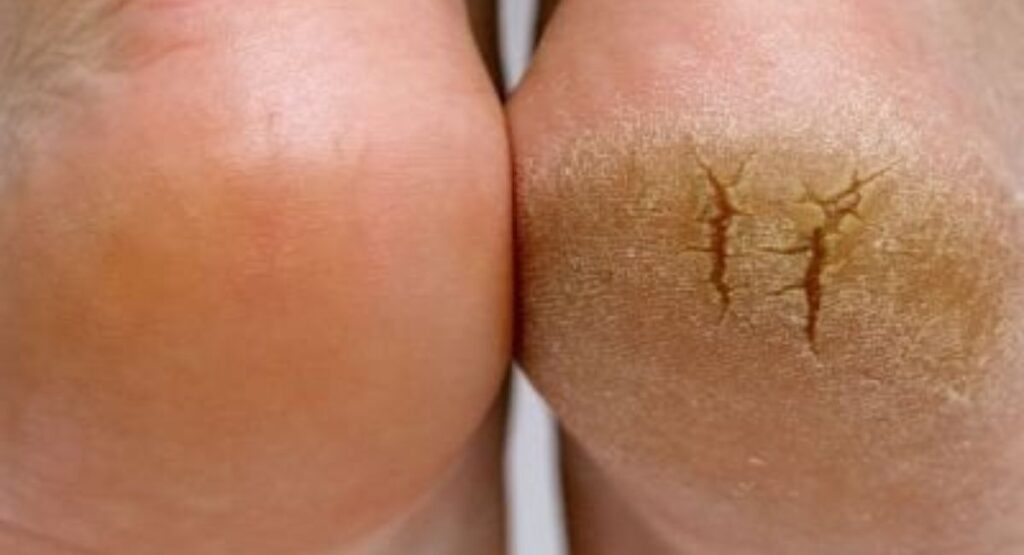 Deep cracks skin by foot fungus.