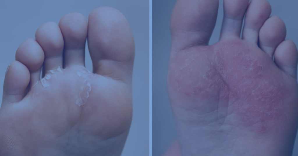 What Fungus Causes Athlete’s Foot?