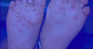 What Fungus Causes Athlete’s Foot?