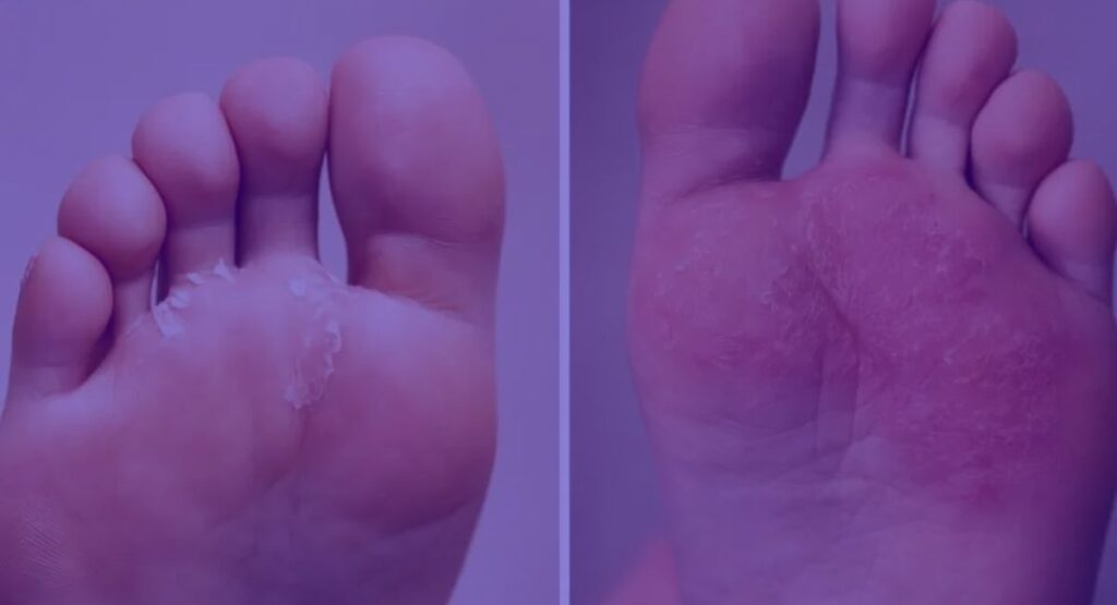 Athlete foot, causes, symptoms